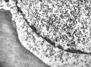 F, 46y. | verruca vulgaris … intranuclear virions F, 46y. | verruca vulgaris … intranuclear virions